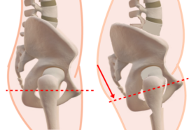 骨盤後傾すると ピラティスチェアーを使って Bridgeスポーツマッサージ治療院
